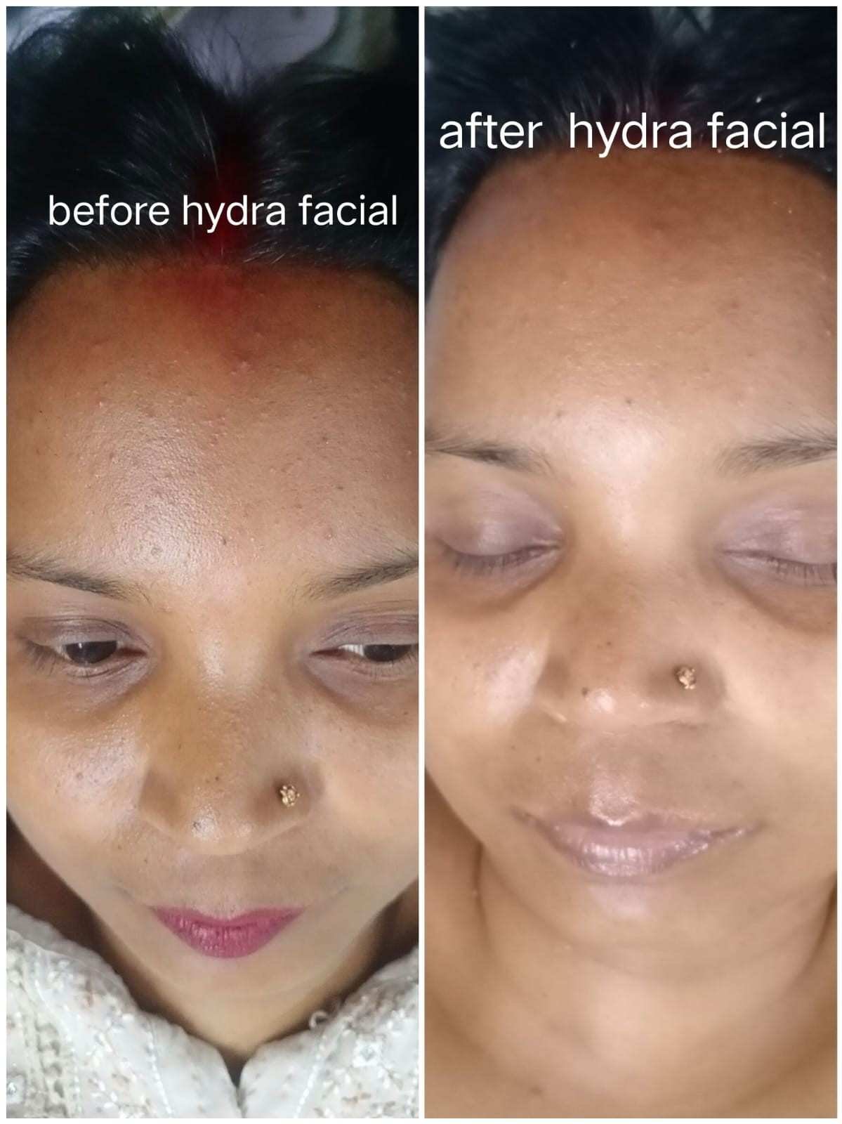 Hydra Facial